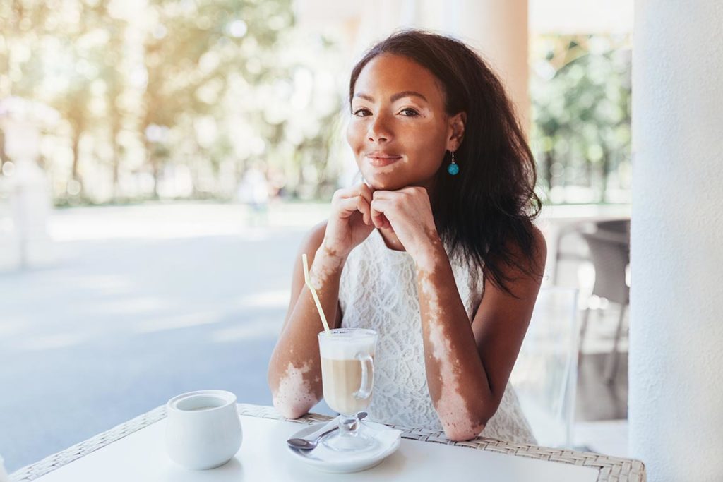 Photo of a woman with vitiligo smiling and drinking coffee.