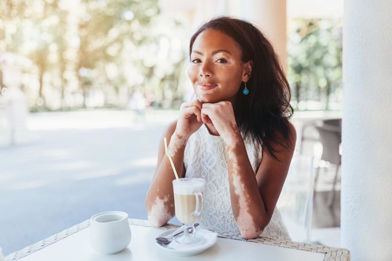 Treating Vitiligo with Phototherapy  National Biological Corporation