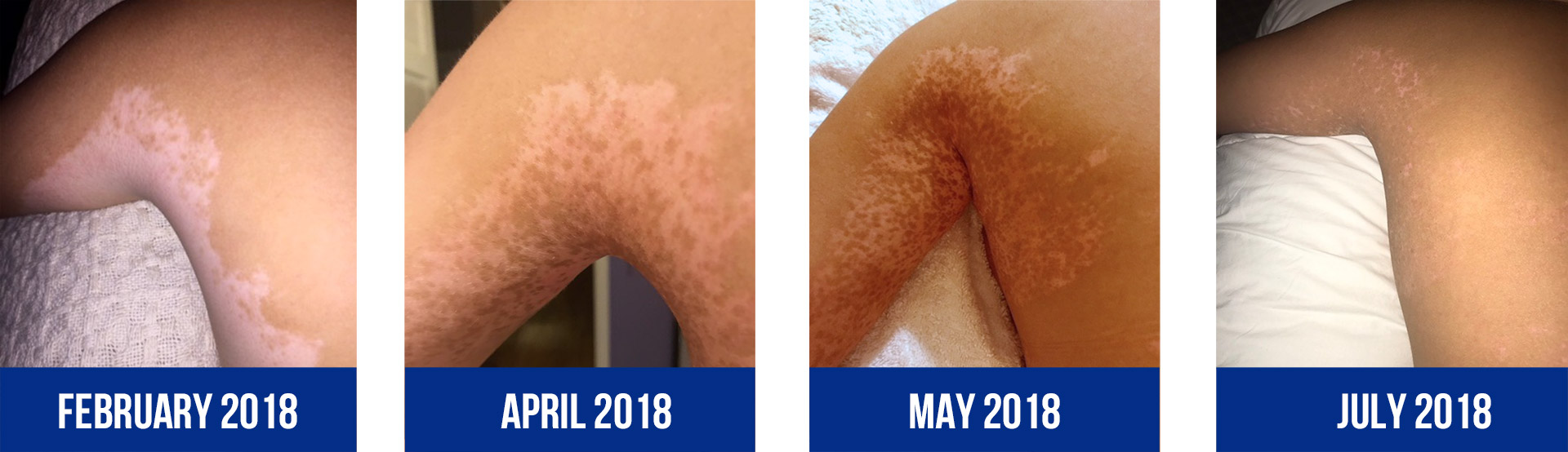 Series of 4 photos from February 2018 through July 2018 showing a patient's shoulder showing progressive regimentation as a result of their UV phototherapy treatments.